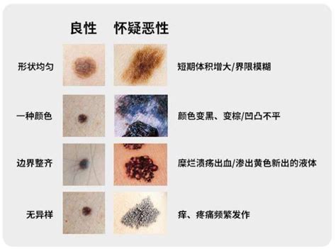 微凸的痣|一图读懂：什么样的痣易癌变？